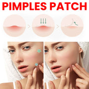 432 Patches Star Heart Acne Pimple Patch Invisible Concealer Waterproof Blemish Spot Pimple Treatment Face Beauty Skin Care